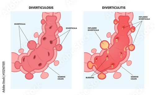 Bowel colon cancer and crohn's disease polyp hernia rectum diverticula ulcer blood stool pain Fecal exam sigmoid diet blocked test C. diff stoma swelling disorder peritonitis rectal