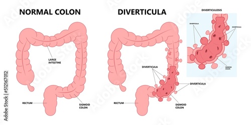 Bowel colon cancer and crohn's disease polyp hernia rectum diverticula ulcer blood stool pain Fecal exam sigmoid diet blocked test C. diff stoma swelling disorder peritonitis rectal photo