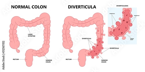 Bowel colon cancer and crohn's disease polyp hernia rectum diverticula ulcer blood stool pain Fecal exam sigmoid diet blocked test C. diff stoma swelling disorder peritonitis rectal