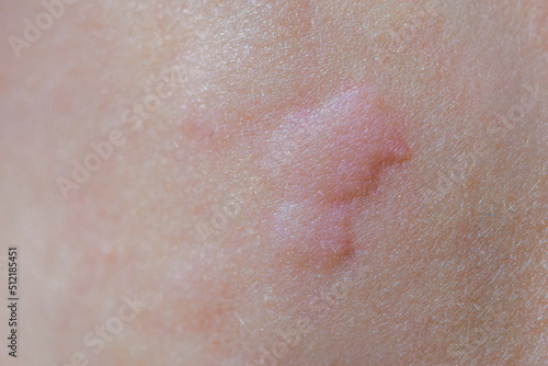 Urticaria on the skin. Red spots of an allergic reaction on the skin of a child. Urticaria symptoms close up photo