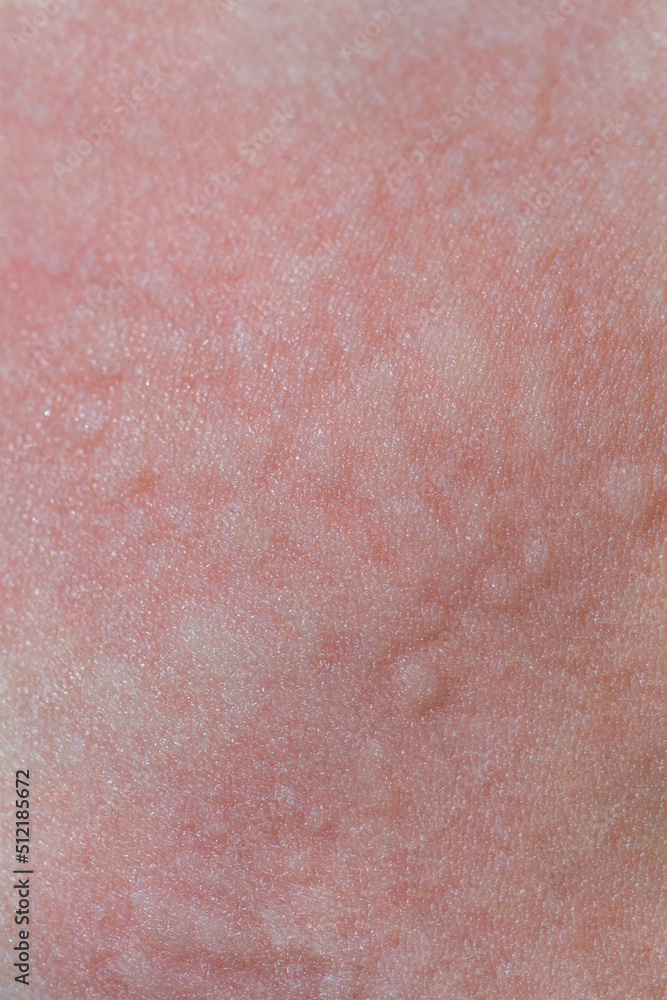 Urticaria on the skin. Red spots of an allergic reaction on the skin of