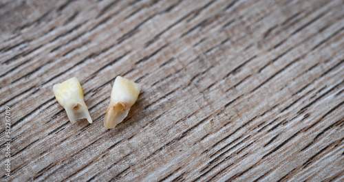 Milk tooth , Close up baby teeth of tooth loss on wooden , milk tooth dental health problems concept