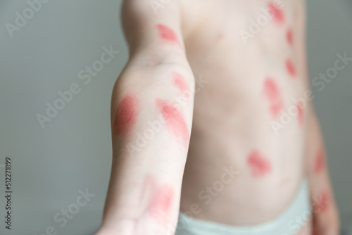 Red rash on the body of child. Monkeypox new disease dangerous over the world. Patient with Monkey Pox, skin diseases. Human body Health problem. Concept of epidemic of monkey pox virus. photo