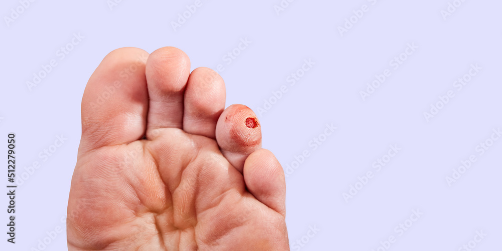 Laser removal of wart from the toe of foot. Cut out verruca