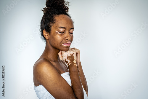 Young brazilian woman with vitiligo posing with towel, skin care and genetic pigmentation concepts