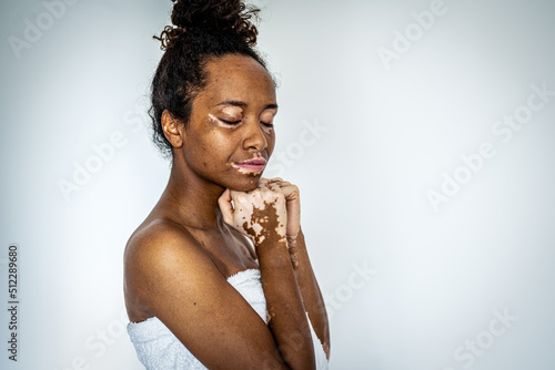 Принти на полотні Young brazilian woman with vitiligo posing with towel, skin care and genetic pig
