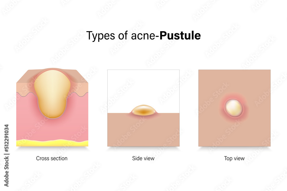 Skin Pustule Model Types of acne. Skin problems. Pustule in cross section, side view and ...