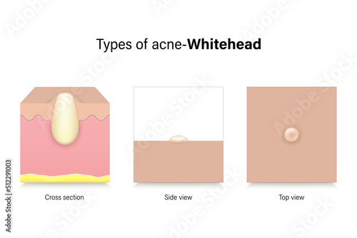 Types of acne. Skin problems. Whitehad in cross section, side view and top view. Vector for advertising about beauty and medical treatment.