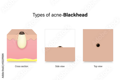 Types of acne. Skin problems. Blackhead in cross section, side view and top view. Vector for advertising about beauty and medical treatment.