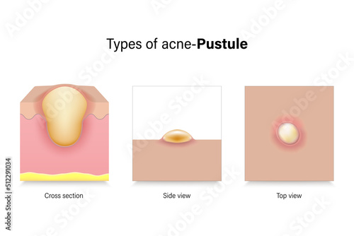 Types of acne. Skin problems. Pustule in cross section, side view and top view. Vector for advertising about beauty and medical treatment.