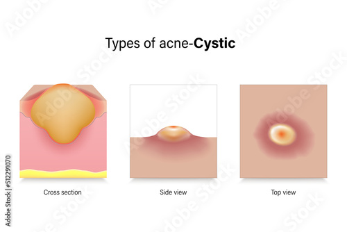 Types of acne. Skin problems. Cystic in cross section, side view and top view. Vector for advertising about beauty and medical treatment.