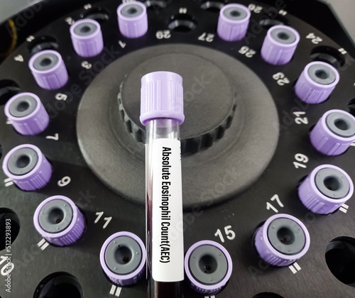 Blood sample for Circulating Eosinophils test at medical laboratory. Diagnosis for allergy photo