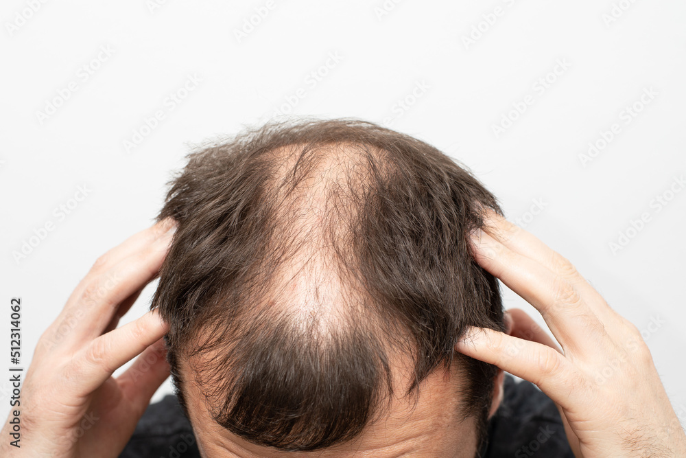 Fototapeta premium Male pattern baldness how to deal with it