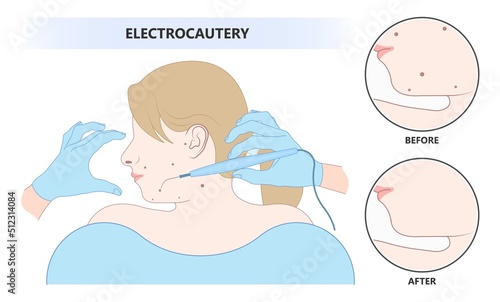 skin care clinic tag cancer face tumor lesion treat warts mole laser gland milia cysts cell inflamed Basal cell layer solar sun spots