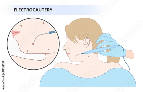 skin care clinic tag cancer face tumor lesion treat warts mole laser gland milia cysts cell inflamed Basal cell layer solar sun spots