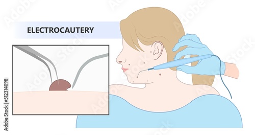skin care clinic tag cancer face tumor lesion treat warts mole laser gland milia cysts cell inflamed Basal cell layer solar sun spots