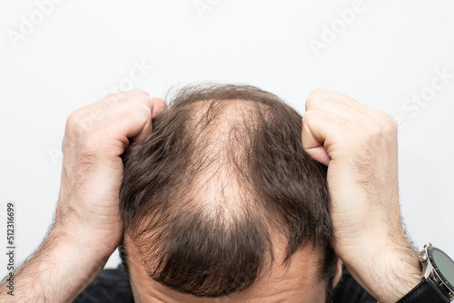 Male pattern baldness how to deal with it