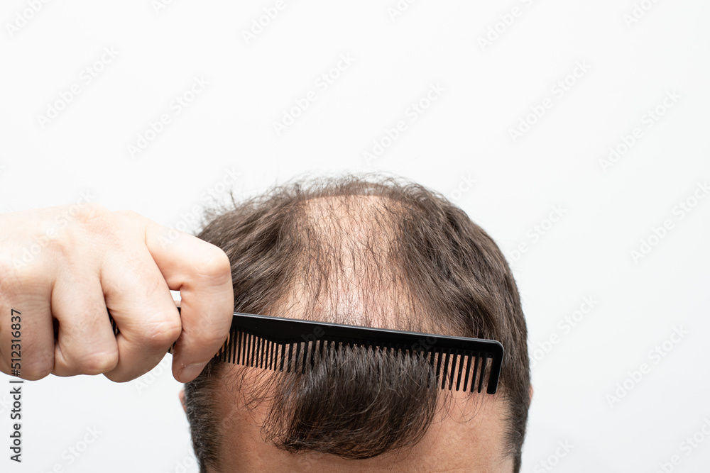 Male pattern baldness how to deal with it Male pattern baldness how to deal with it