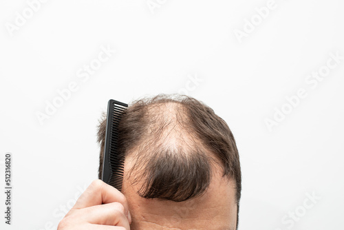 Male pattern baldness how to deal with it