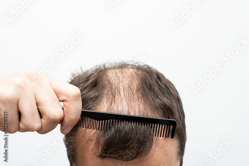 Male pattern baldness how to deal with it