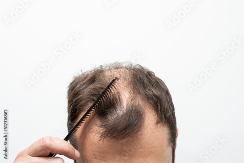 Male pattern baldness how to deal with it