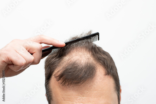 Male pattern baldness how to deal with it
