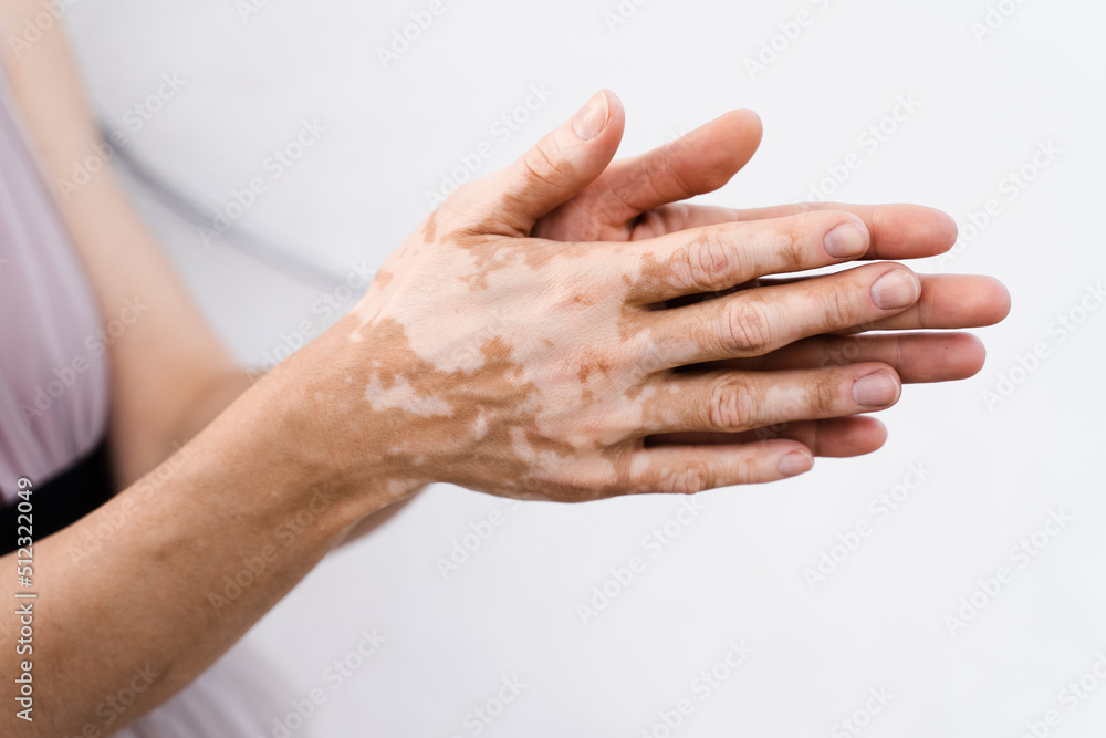 Hands with vitiligo skin pigmentation on white background close-up. Lifestyle with Seasonal skin diseases.