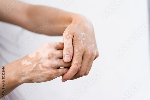 Hands with vitiligo skin pigmentation on white background close-up. Lifestyle with Seasonal skin diseases. photo