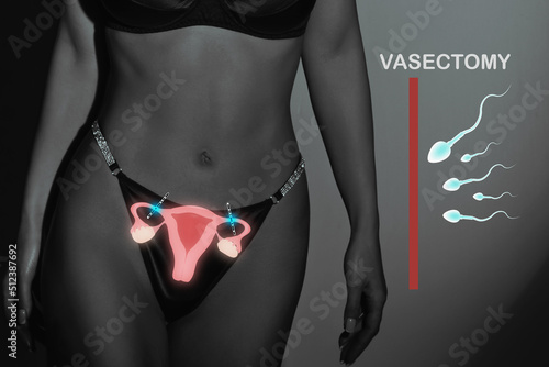 Photography Female sterilization, uterus and female body silhouette, vasectomy
