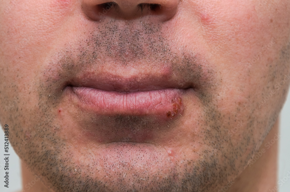 Fototapeta premium Man applying ointment to herpes on lips for treatment