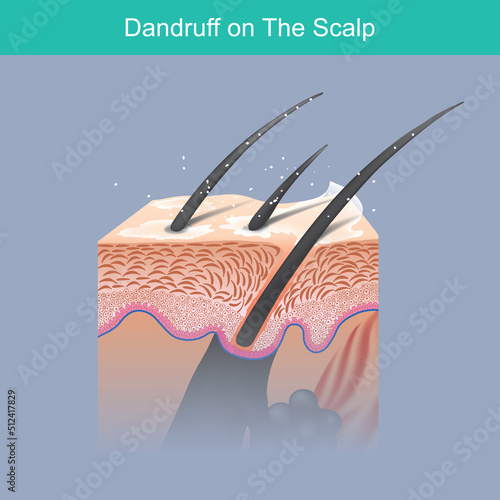 Dandruff on the scalp. Hair illustration for a problem dandruff on the scalp falls off like dust or flakes. Infographic..