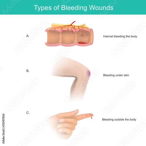 Types of Bleeding Wounds. Bleeding is the loss of blood, inside or outside the body. Illustration infographic..