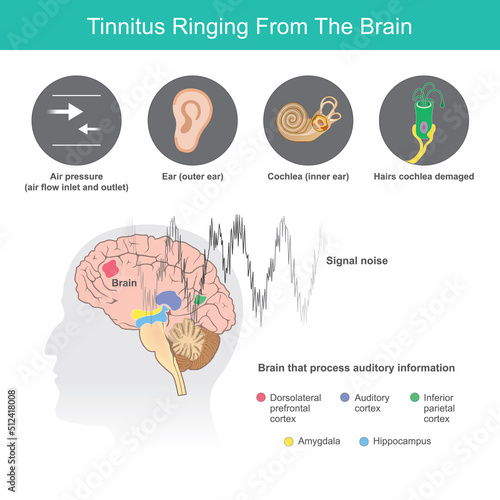 Tinnitus Ringing From The Brain, Is the term for a buzzing noise in your ears from symptoms abnormal in ears or the brain..