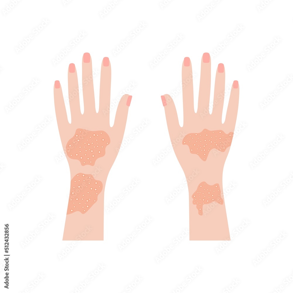 Human hands with psoriasis and rashes. Red eczema eruptions and inflamed eczema. Allergic urticaria problems and infectious vector smallpox infection Human hands with psoriasis and rashes. Red eczema eruptions and inflamed eczema. Allergic urticaria problems and infectious vector smallpox infection