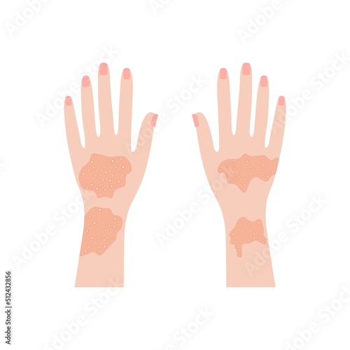 Human hands with psoriasis and rashes. Red eczema eruptions and inflamed eczema. Allergic urticaria problems and infectious vector smallpox infection