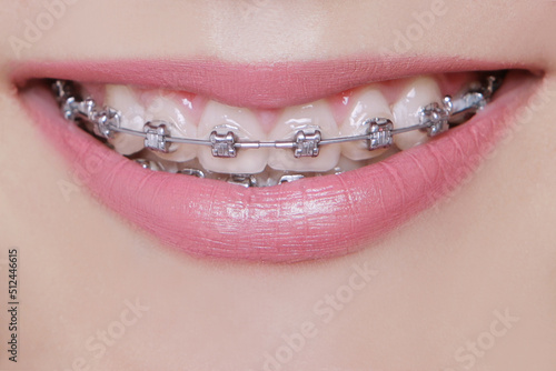 metal braces on young girl's teeth