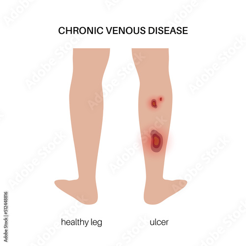 Trophic ulcer anatomy © pikovit