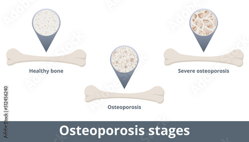 Osteoporosis stages. Disease develops when bone mineral density and bone mass decrease. Visualization includes healthy bone, osteoporosis, and severe osteoporosis.