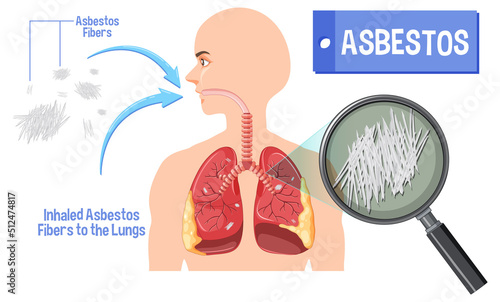 Diagram showing asbestosis in lungs