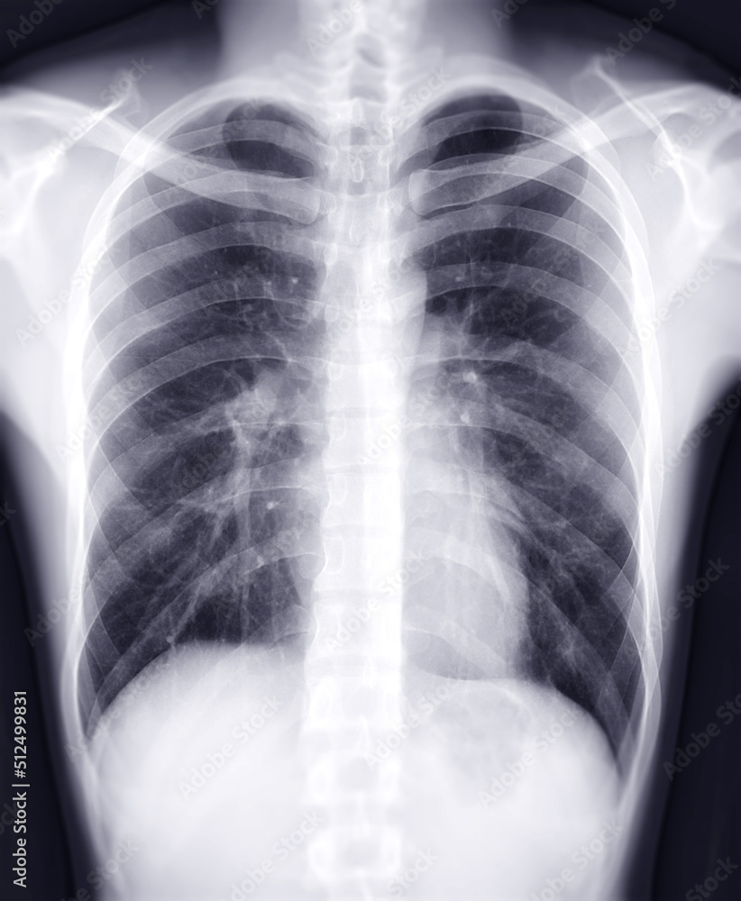 Chest x-ray image for diagnosis TB,tuberculosis and covid-19. Chest x-ray image for diagnosis TB,tuberculosis and covid-19.