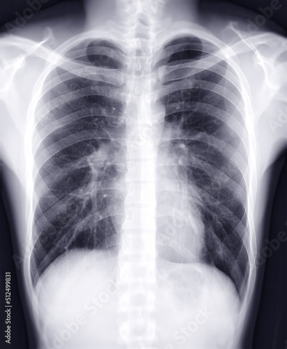 Chest x-ray image for diagnosis TB,tuberculosis and covid-19.