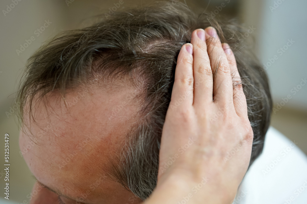 Fototapeta premium Baldness on the head of a middle-aged man. Hair loss.