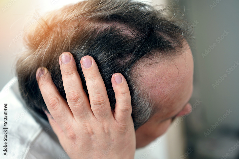Fototapeta premium Baldness on the head of a middle-aged man. Hair loss.