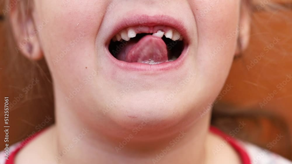 Cropped face of close up girl mouth, toothy smile, baby milk teeth. Tongue touching sagging front white tooth. Changing teeth to permanent. Help to remove. Medicine dentistry, healthcare and hygiene. Cropped face of close up girl mouth, toothy smile, baby milk teeth. Tongue touching sagging front white tooth. Changing teeth to permanent. Help to remove. Medicine dentistry, healthcare and hygiene.