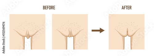 Labioplasty (vaginoplasty). Changes in the female labia, before and after