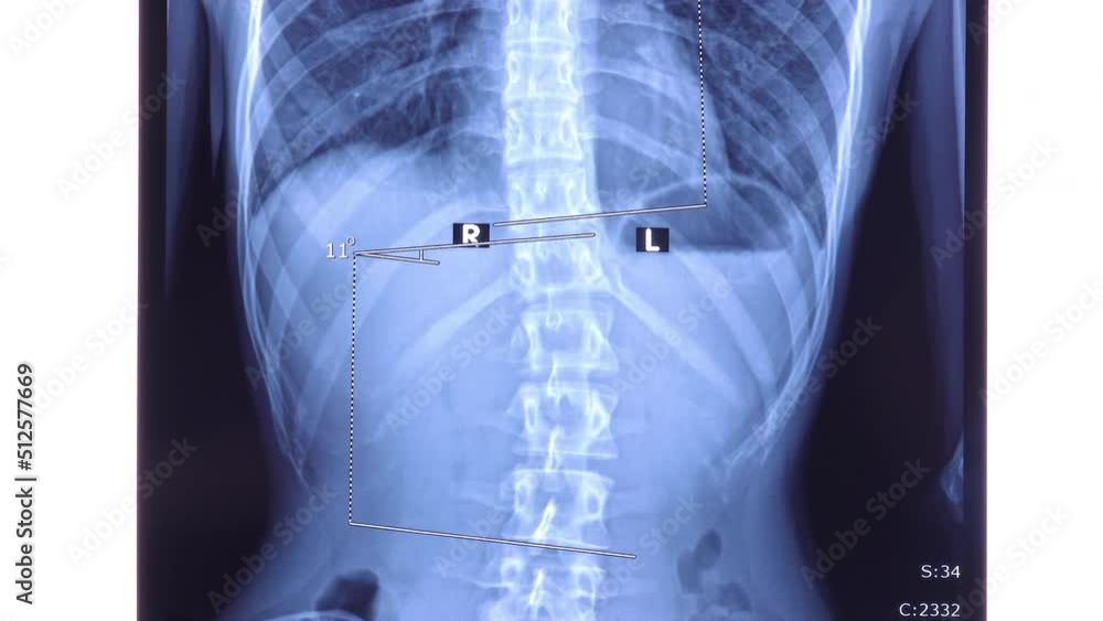x-ray-of-the-spine-showing-scoliosis-in-the-lumbar-area-scoliosis-is