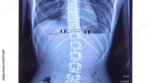 X ray of the spine showing scoliosis in the lumbar area. Scoliosis is an abnormal lateral curvature of the spine. Dolly shot 4k