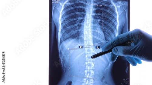 Doctor analyzing X ray of the spine showing scoliosis in the lumbar area. Scoliosis is an abnormal lateral curvature of the spine. Dolly shot 4k