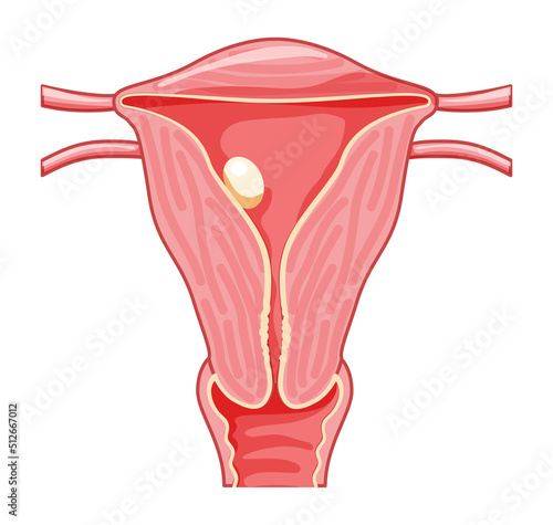 Sessile Polyp in the uterus Female reproductive system in cross sections. Front view in a cut. Human anatomy diseases internal organs location scheme, cervix, ovary, fallopian tube flat style icon