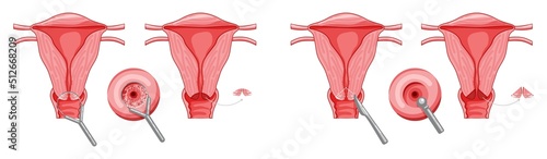 Set of Cervical Dysplasia Female reproductive system uterus cancer carcinoma in different styles and cross sections. Front view in a cut. Human anatomy internal organs location scheme flat style icon photo
